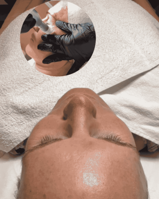 Microneedling München
