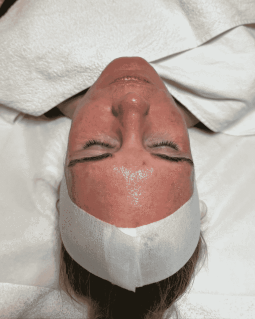 Microneedling München im Königstöchter Schönheitszentrum